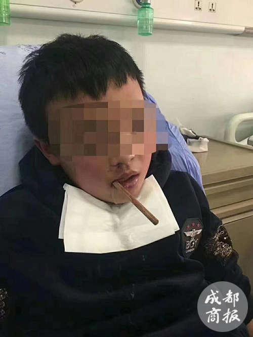 孩子被筷子插喉咙